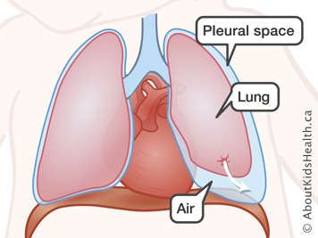 The lung, pleural space and air in the pleural space, with an arrow from a spot on the lung to the pleural space