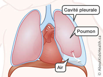 Le poumon, la cavit&eacute; pleurale et l&rsquo;air dans la cavit&eacute;, avec une fl&egrave;che d&rsquo;une tache sur le poumon &agrave; la cavit&eacute; pleurale