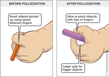 Hand before pollicization gripping pen between fingers and hand after with a larger grip, holding pen between fingertips