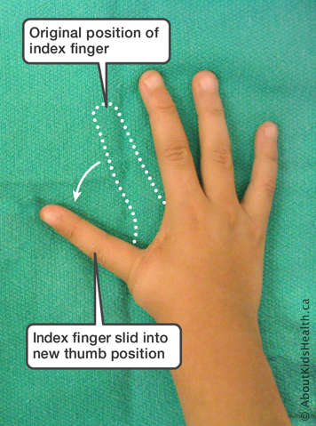 Hand with index finger slid into new thumb position and original position of index finger indicated with dotted line