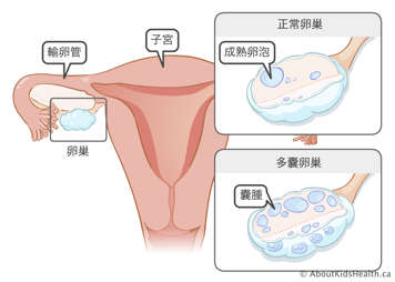 子宮、輸卵管和卵巢；帶有一個成熟卵泡的正常卵巢；以及含有囊腫的多囊卵巢