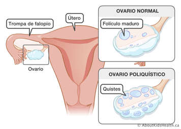 El útero, las trompas de Falopio y el ovario; un ovario normal con un folículo maduro; y un ovario poliquístico con quistes