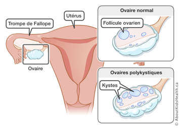 L'utérus, la trompe de Fallope et l'ovaire sont identifiés, aussi qu’un ovaire normal et un ovaire polykystique