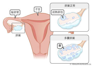 子宫、输卵管和卵巢；带有一个成熟卵泡的正常卵巢；以及含有囊肿的多囊卵巢