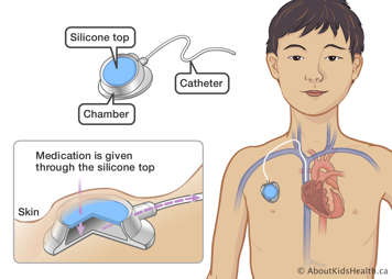 Silicone top, chamber and catheter identified in a port located under the skin and in a large vein in a child’s chest