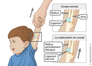 Radius, ulna et ligament du coude normal, et radius partiellement disloqué et ligament déchiré en cas de subluxation du coude