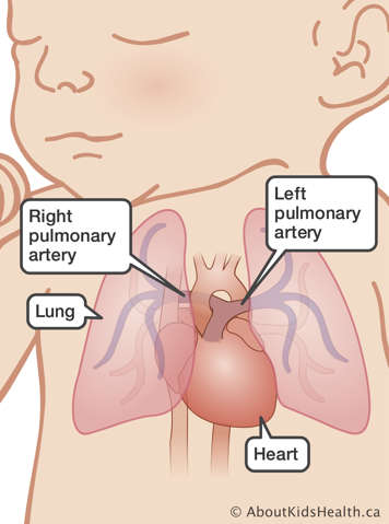 Right pulmonary artery, left pulmonary artery, lung and heart in a baby