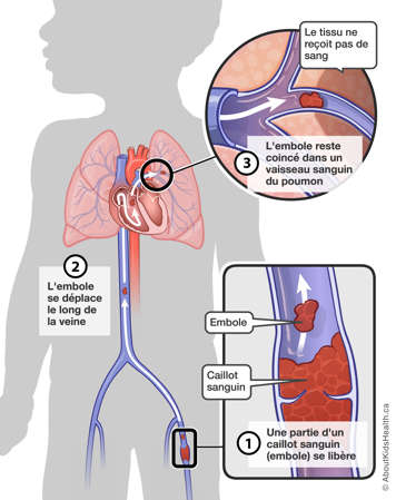 Partie d’un caillot sanguin se libérant, se déplaçant le long de la veine et se coinçant dans un vaisseau sanguin du poumon