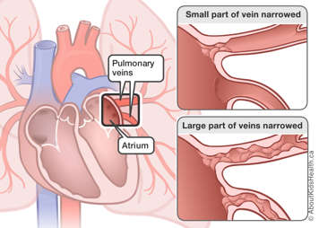 Illustration of small part of vein narrowed and large part of veins narrowed