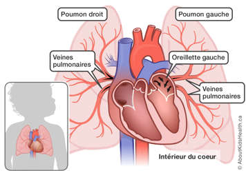 Vue de l’intérieur du cœur, montrant du sang entrant dans l’oreillette gauche depuis les veines pulmonaires des deux poumons