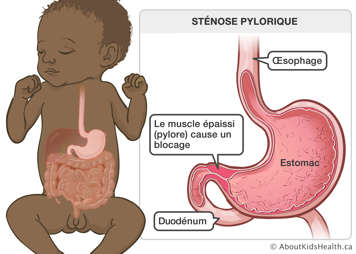 L’œsophage, l’estomac et le duodénum d’un bébé avec un muscle épaissi (pylore) causant un blocage dessous l’estomac