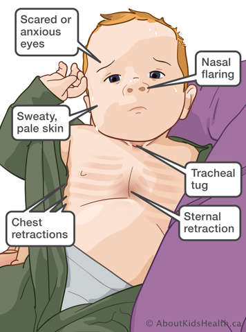 Baby showing signs of respiratory distress including scared/anxious eyes, nasal flaring, sweaty pale skin, tracheal tug, chest retractions, sternal retraction