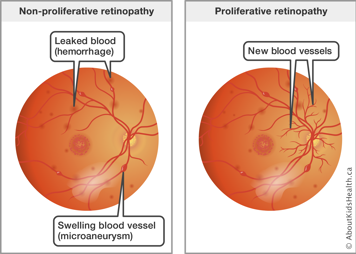Side by side comparison of the retina of the eye with non-proliferative retinopathy versus proliferative retinopathy