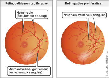 Parallèle entre une rétinopathie non proliférative et une rétinopathie proliférative sur la rétine de l’œil 