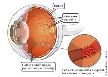 Cellules malades bloquent les vaisseaux sanguins dans l'œil, résultant en une rétine endommagée