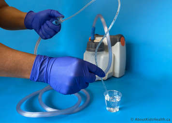 Person dipping a tracheostomy catheter into sterile water to clear the suction catheter