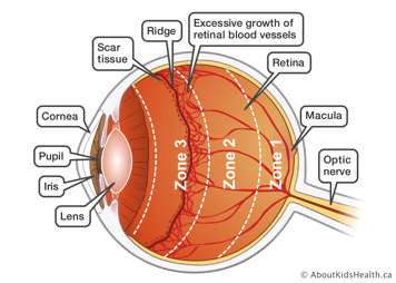 The anatomy of a premature eye with scar tissue and excessive growth of retinal blood vessels