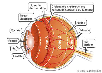 L’anatomie d’un œil avec du tissu cicatriciel et la croissance excessive des vaisseaux sanguins de la rétine