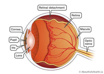 The anatomy of an eye with retinal detachment along the top and bottom