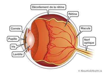 L’anatomie d’un œil avec décollement de la rétine du haut et du bas de l’œil