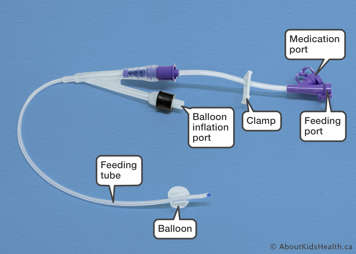 Rusch catheter showing feeding tube, feeding port, medication port, balloon port and balloon