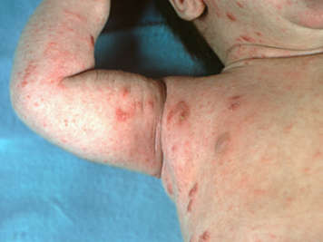 Infant with scabies on arm, shoulder and armpit