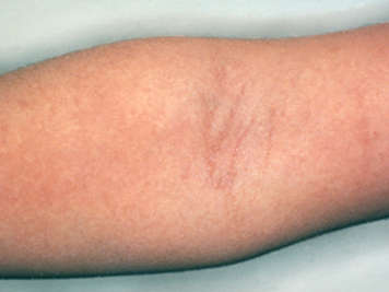 Scarlet fever rash on arm, in elbow crease