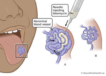 Needle injecting bleomycin into abnormal blood vessel