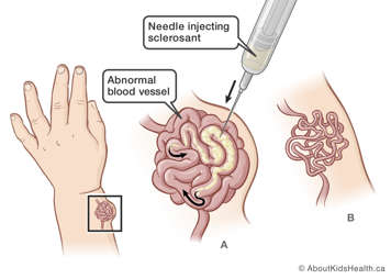 Needle injecting sclerosant into abnormal blood vessel
