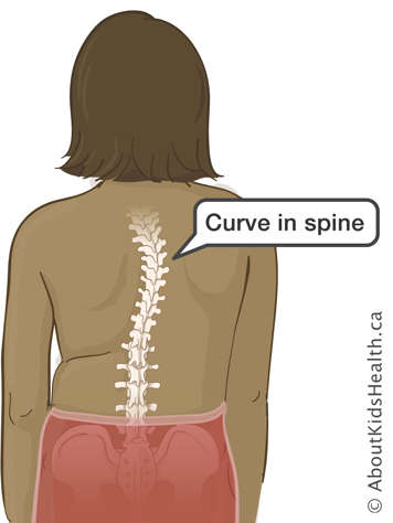 Person’s back with a curve in the spine