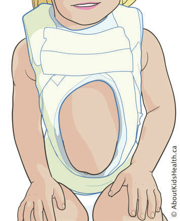 Young child with a body cast over shoulders and abdomen