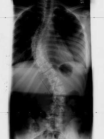 X-ray image of spine with scoliosis