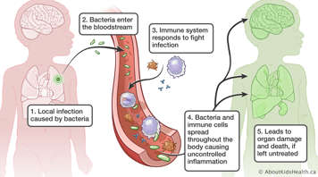 Medical illustration of bacteria entering the blood stream and spreading throughout the body, leading to sepsis
