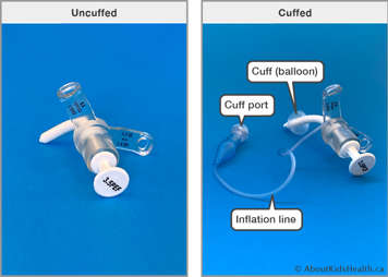 Uncuffed tracheostomy tube and cuffed tracheostomy tube showing the cuff port, cuff (balloon) and inflation line