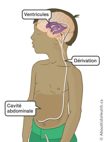 Une dérivation insérée dans un ventricule du cerveau d’un garçon et passant par le corps jusqu’à son cavité abdominale