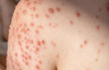 Chicken pox showing red fluid-filled blisters