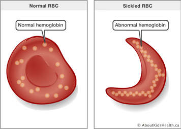 A red blood cell with normal hemoglobin molecules and a sickled red blood cell with abnormal hemoglobin molecules