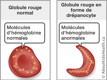 Une globule rouge avec les molécules d’hémoglobine normales et une globule rouge avec les molécules d’hémoglobine anormales