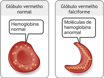 Glóbulo vermelho com moléculas de hemoglobina normais e glóbulo vermelho falciforme com moléculas de hemoglobina anormais