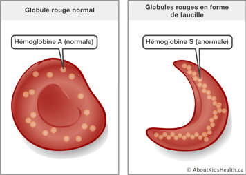 Globule rouge normale avec hémaglobine A et globule rouge en forme de faucille avec hémoglobine S