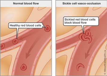 Normal blood flow with healthy red blood cells compared to blocked blood flow from sickled red blood cells