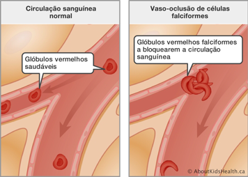 Circulação sanguínea normal com glóbulos vermelhos saudáveis, e vaso-oclusão causada por glóbulos vermelhos falciformes