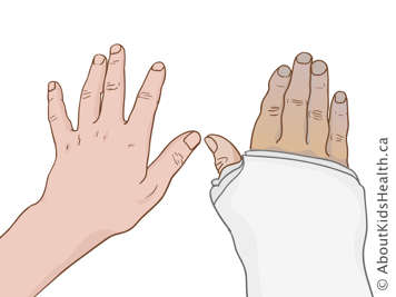 Main décolorée dans un plâtre comparée à l’autre main de couleur normal