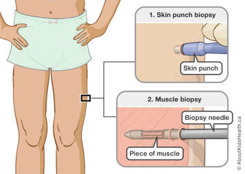 Illustration of a skin punch biopsy and a muscle biopsy