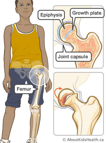 Epiphysis, growth plate and joint capsule of the femur with separation between epiphysis and growth plate