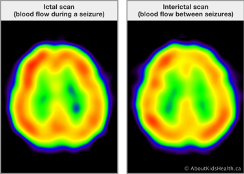 Ictal scan of the brain showing blood flow during seizure and interictal scan showing blood flow between seizures 