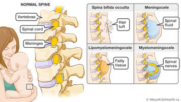 Vertebrae, spinal cord and meninges in normal spine, and illustrations of spines with the four forms of spina bifida