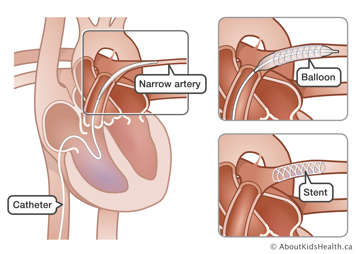 A catheter in the heart and into a narrow artery, close-up of a balloon on the end of the catheter, and a stent in the artery