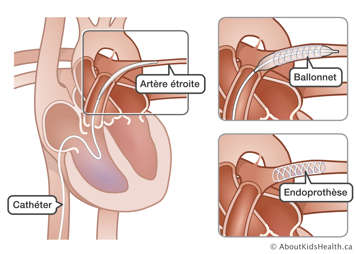 Un cathéter à travers le cœur et dans une artère étroite, et un gros plan d’un ballonnet et d’une endoprothèse dans l’artère
