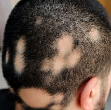 Back and side of a person's head with very short black hair and multiple patches of hair loss